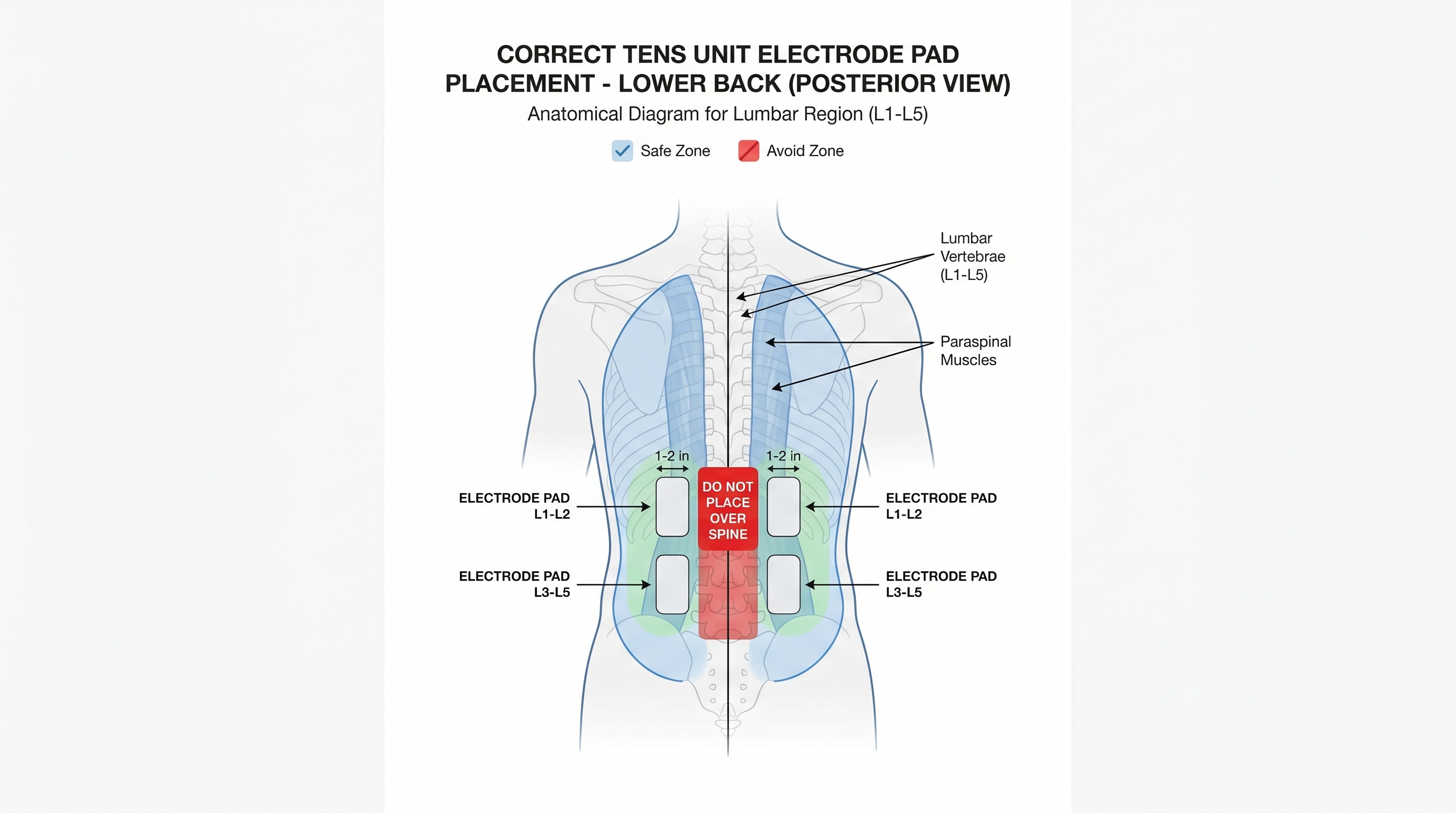 TENS electrode placement diagram showing correct positioning on lower back for chronic pain relief