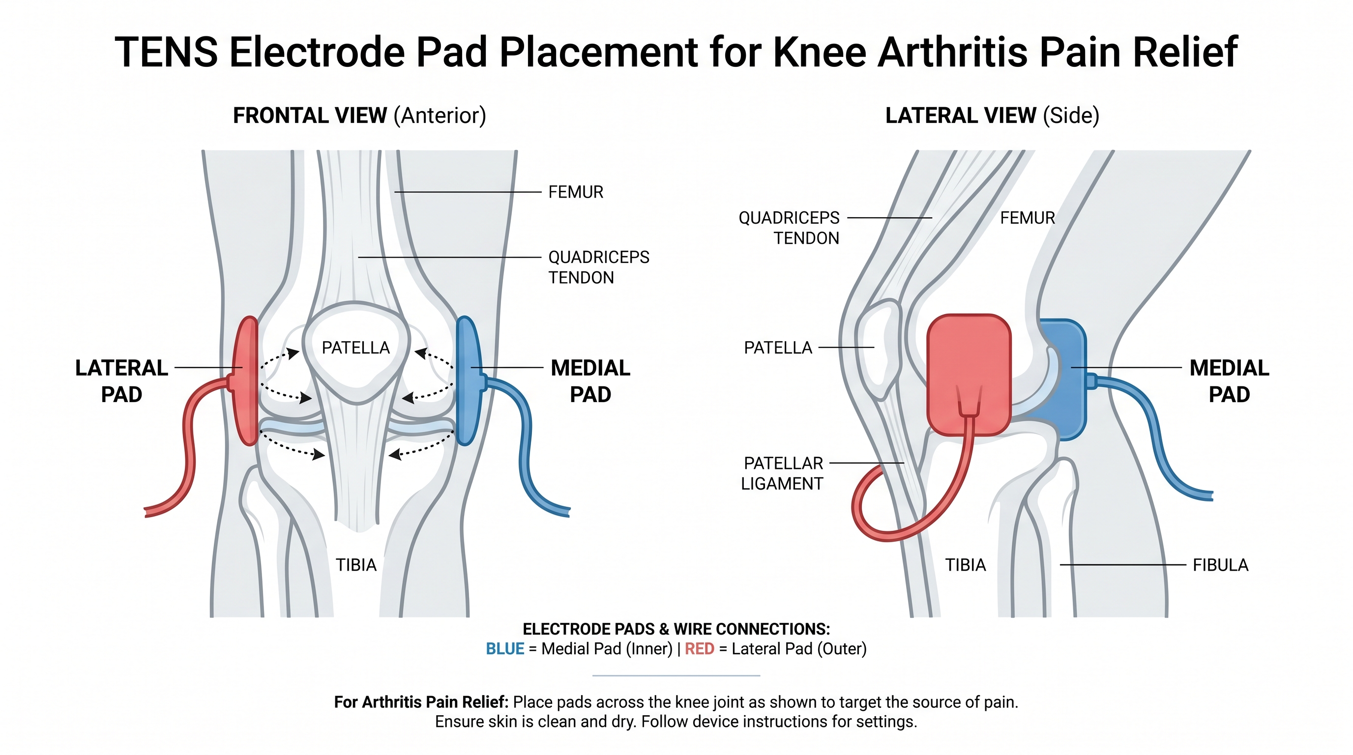 TENS electrode pad placement guide for knee arthritis pain relief at home