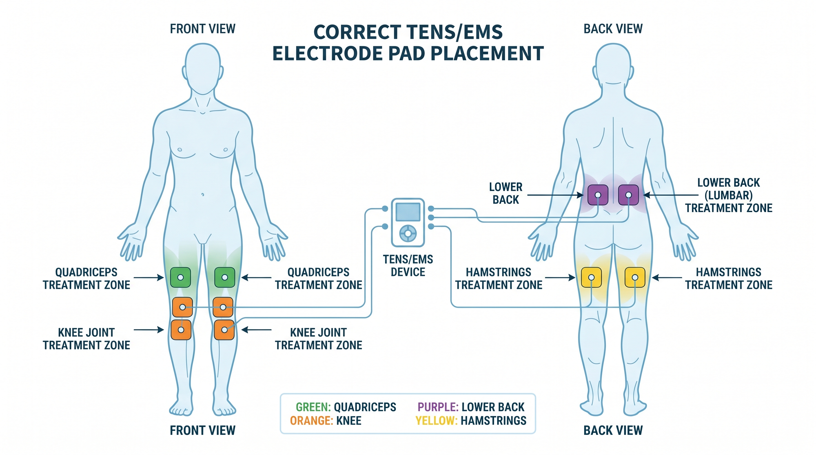 Electrode pad placement guide for iStim EV-805 EV-804 X1 TENS EMS therapy